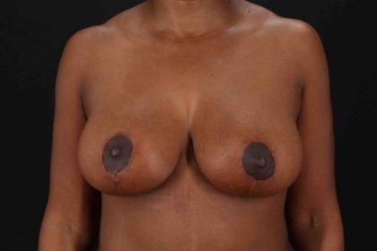 Breast Reduction with Lift Before & After Patient #883