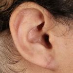 Earlobe Repair Before & After Patient #1791