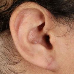 Earlobe Repair Before & After Patient #1791