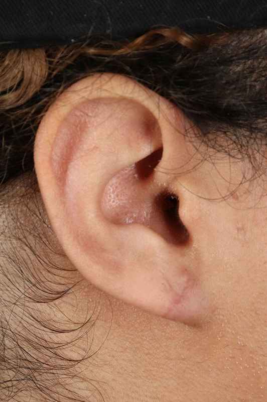 Earlobe Repair Before & After Patient #1791