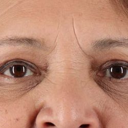 Eyelid Surgery Before & After Patient #1803