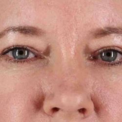Eyelid Surgery Before & After Patient #1814