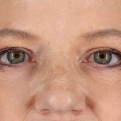 Eyelid Surgery Before & After Patient #1825