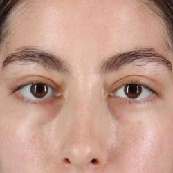 Eyelid Surgery Before & After Patient #1836