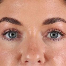 Eyelid Surgery Before & After Patient #1847