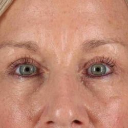 Eyelid Surgery Before & After Patient #1858