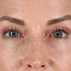 Eyelid Surgery Before & After Patient #1869