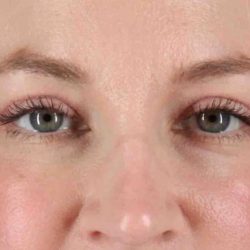 Eyelid Surgery Before & After Patient #1880