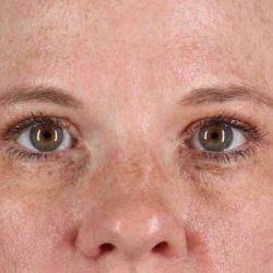 Eyelid Surgery Before & After Patient #1891