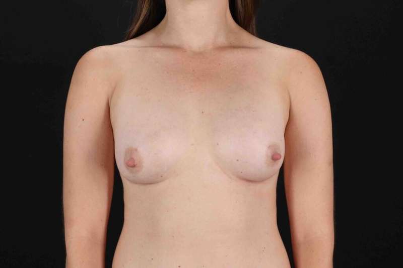 Breast Augmentation with Fat Transfer Before & After Patient #784