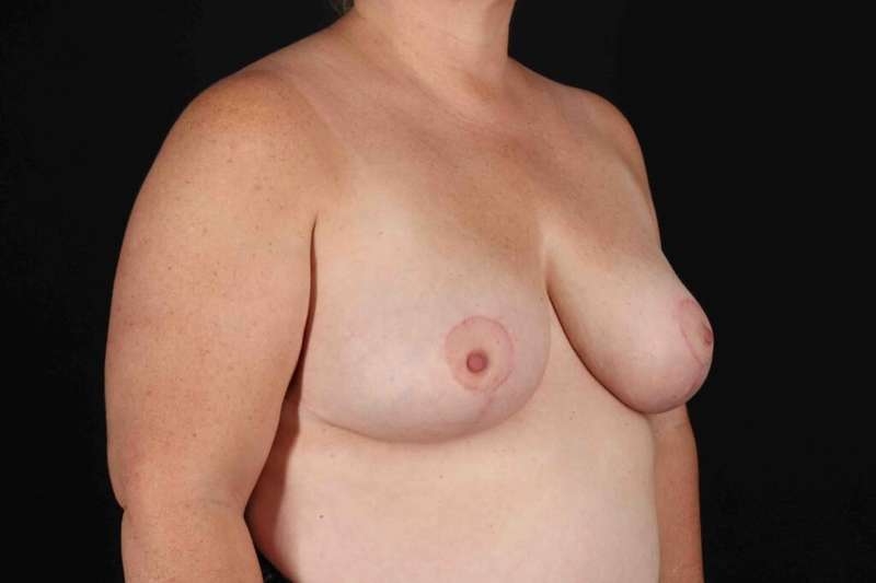Breast Reduction with Lift Before & After Patient #894