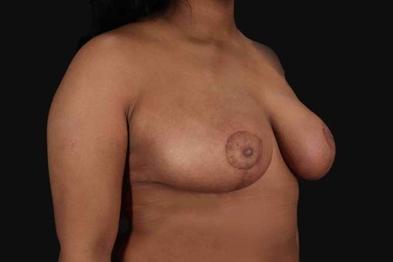 Breast Reduction with Lift Before & After Patient #905