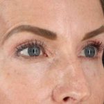 CO2 Laser Before & After Patient #2070