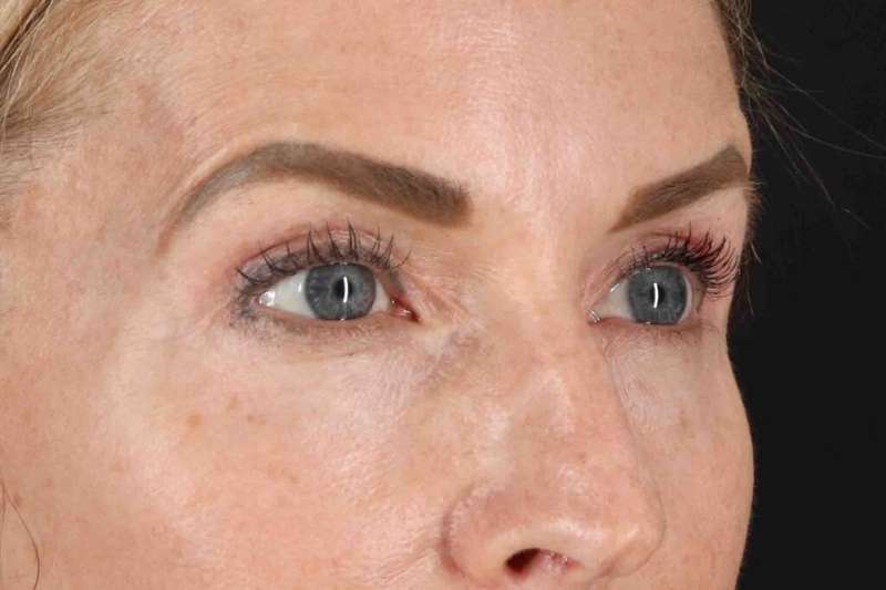 Laser Before & After Patient #2070
