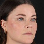 CO2 Laser Before & After Patient #2092