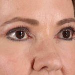CO2 Laser Before & After Patient #2114