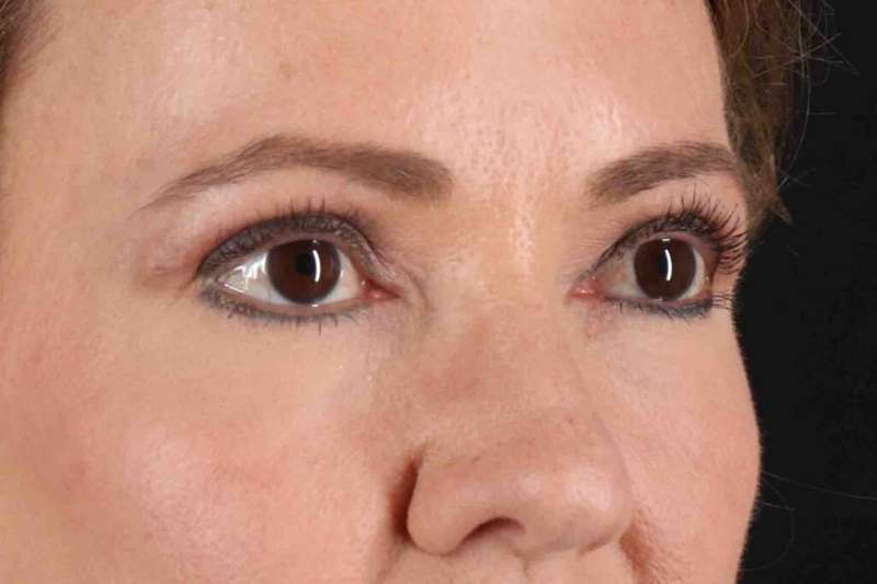 Laser Before & After Patient #2114