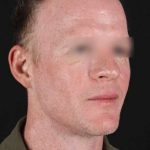 CO2 Laser Before & After Patient #2158