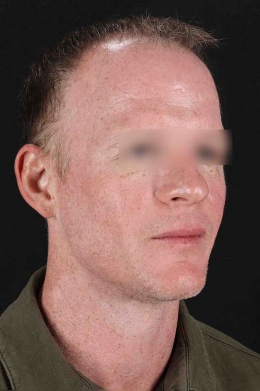 Laser Before & After Patient #2158