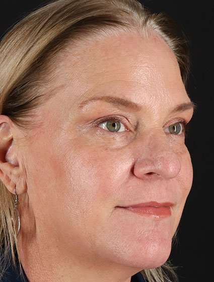 Chemical Peel Before & After Patient #2169