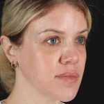Chemical Peel Before & After Patient #2180