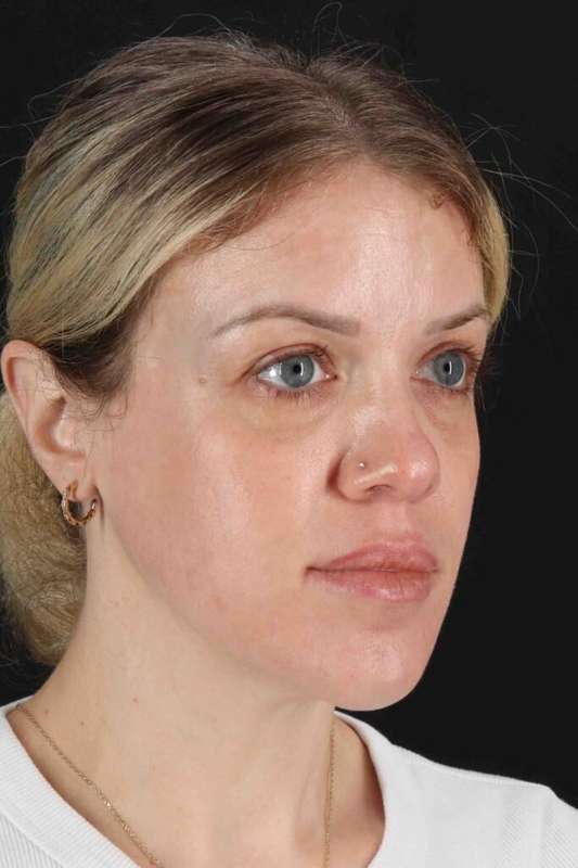 Chemical Peel Before & After Patient #2180