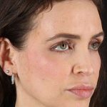 Chemical Peel Before & After Patient #2202