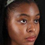 Chemical Peel Before & After Patient #2213