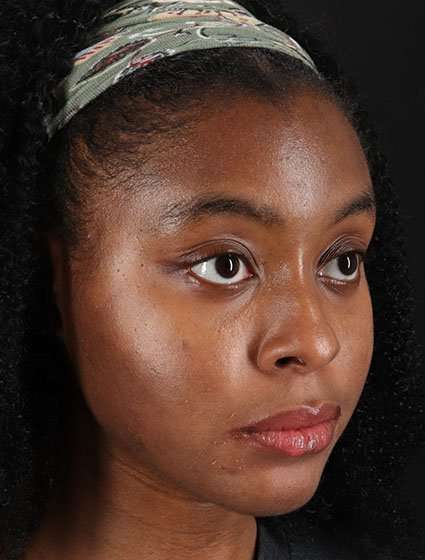 Chemical Peel Before & After Patient #2213