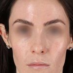 Cosmetic Injectables Before & After Patient #2236