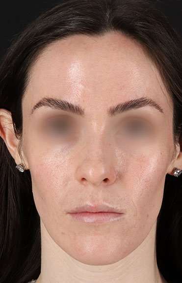 Cosmetic Injectables Before & After Patient #2236