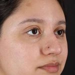 Cosmetic Injectables Before & After Patient #2253