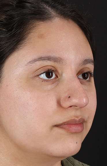 Cosmetic Injectables Before & After Patient #2253