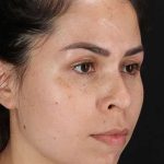 Cosmetic Injectables Before & After Patient #2264