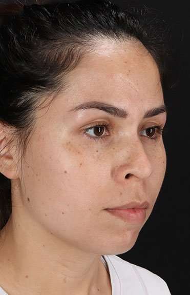 Cosmetic Injectables Before & After Patient #2264