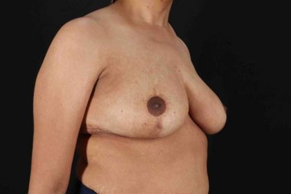 Breast Reduction with Lift Before & After Patient #1005