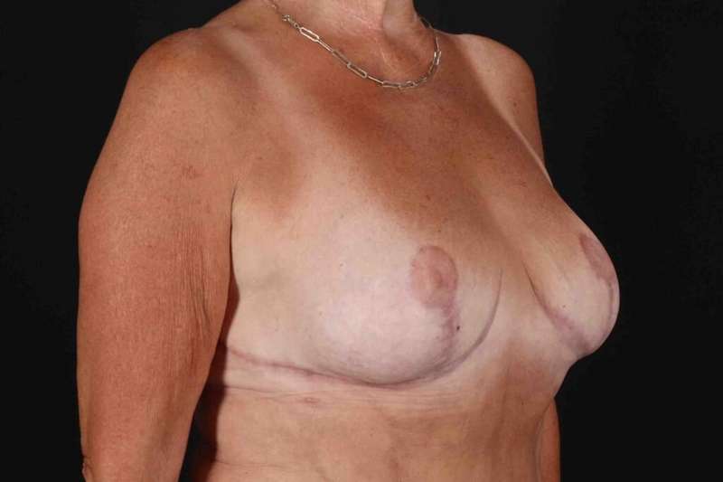 Breast Reduction with Lift Before & After Patient #1016