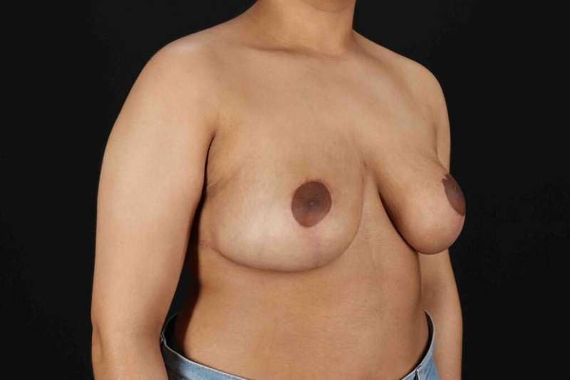 Breast Reduction with Lift Before & After Patient #1027