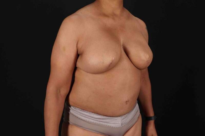 Breast Reconstruction Before & After Patient #1038