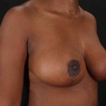 Breast Lift Before & After Patient #1049
