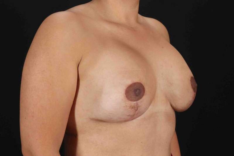 Breast Lift Before & After Patient #1082