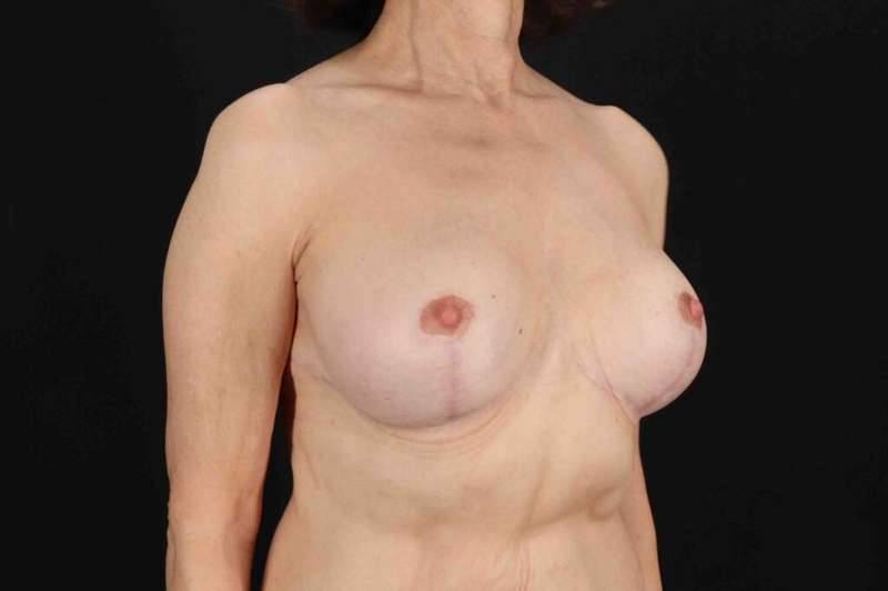 Breast Lift Before & After Patient #1137