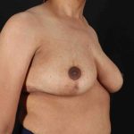 Breast Lift Before & After Patient #1159
