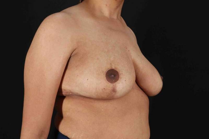 Breast Lift Before & After Patient #1159