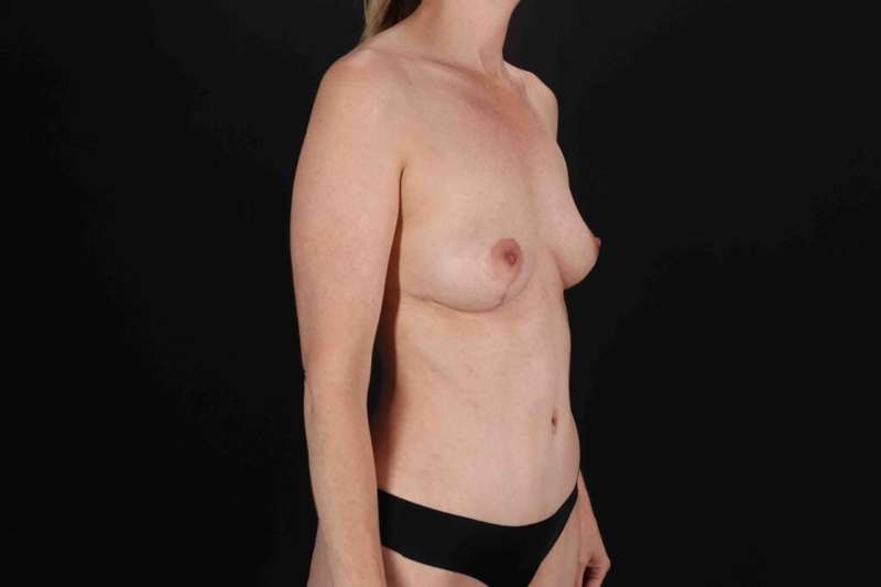Mommy Makeover Before & After Patient #1327
