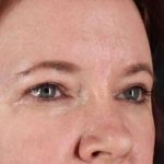 Brow Lift Before & After Patient #1566