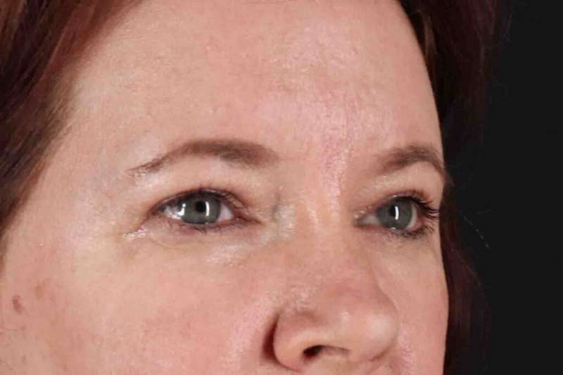 Brow Lift Before & After Patient #1566