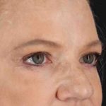 Brow Lift Before & After Patient #1577