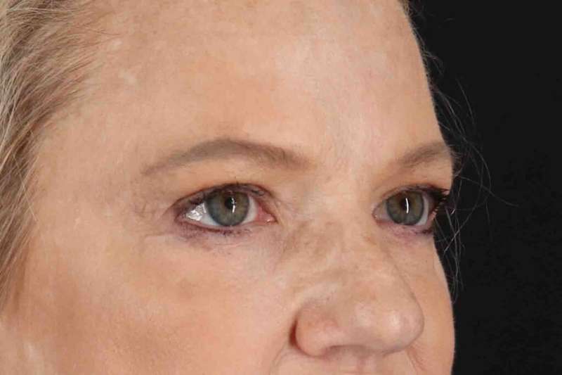 Brow Lift Before & After Patient #1577