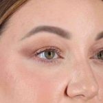 Brow Lift Before & After Patient #1588